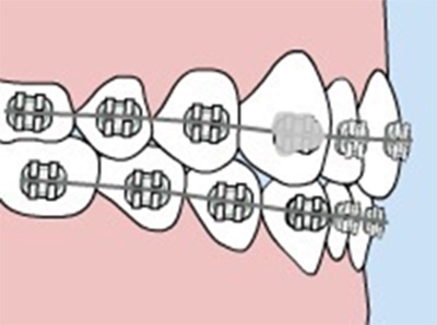 Pokey Braces Wire Causing You Pain? Here's How to Fix It in a