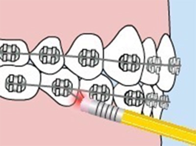 Pokey Braces Wire Causing You Pain? Here's How to Fix It in a